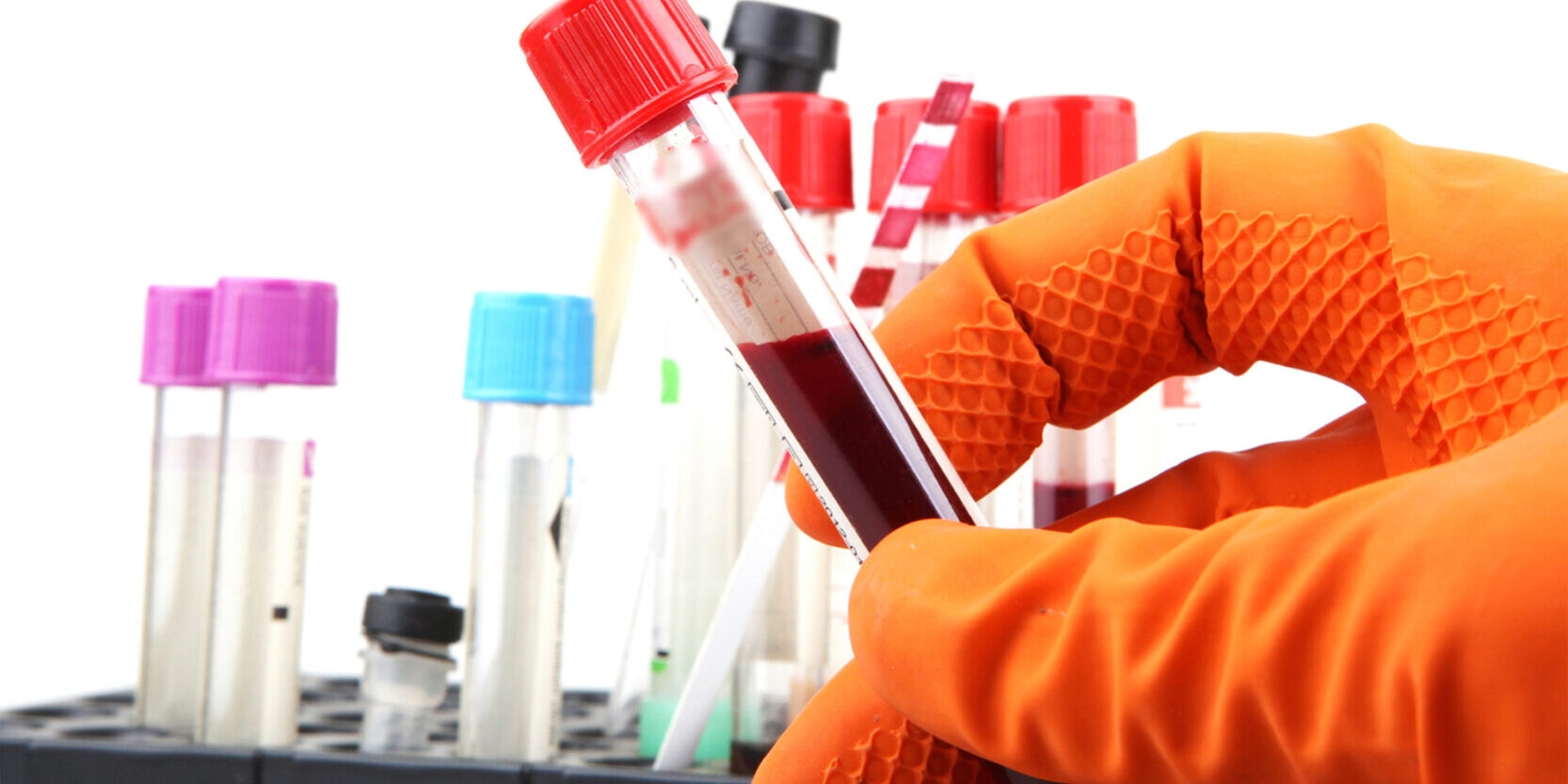 cropped-hand-scientist-holding-blood-sample-vial 2